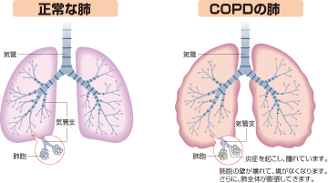 copd肺